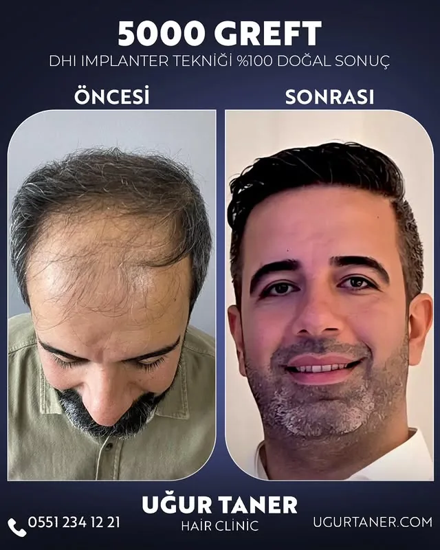 5000 greft DHI saç ekimi vaka paylaşımı – Uğur Taner Hair Clinic Instagram