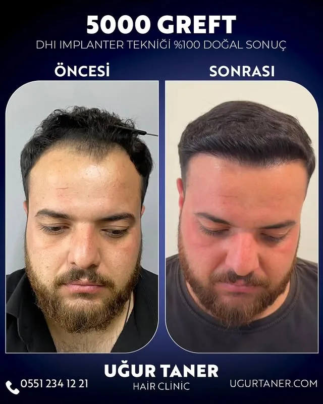 5000 greft DHI saç ekimi vaka paylaşımı – Uğur Taner Hair Clinic Instagram